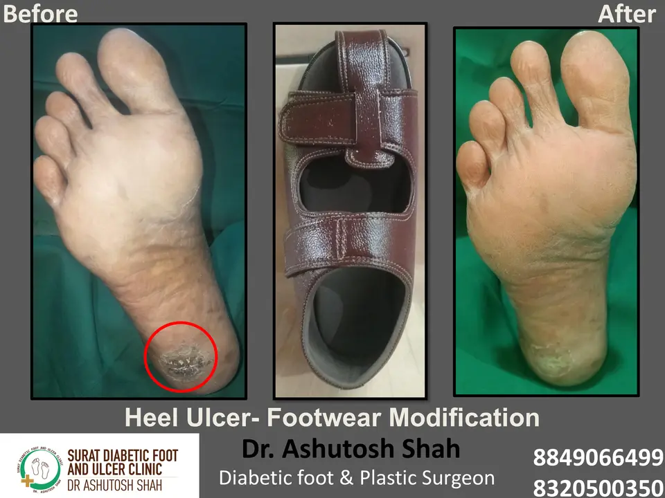 Diabetic Foot  PPT 3 checked by sir.pptx-20.webp